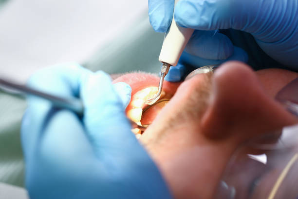 Best Emergency Dentist for Lost Fillings or Crowns in Medina, OH